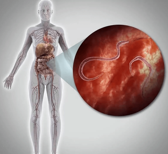 Parasites dans le corps humain