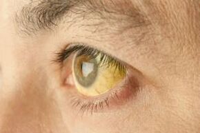 jaunissement du blanc des yeux